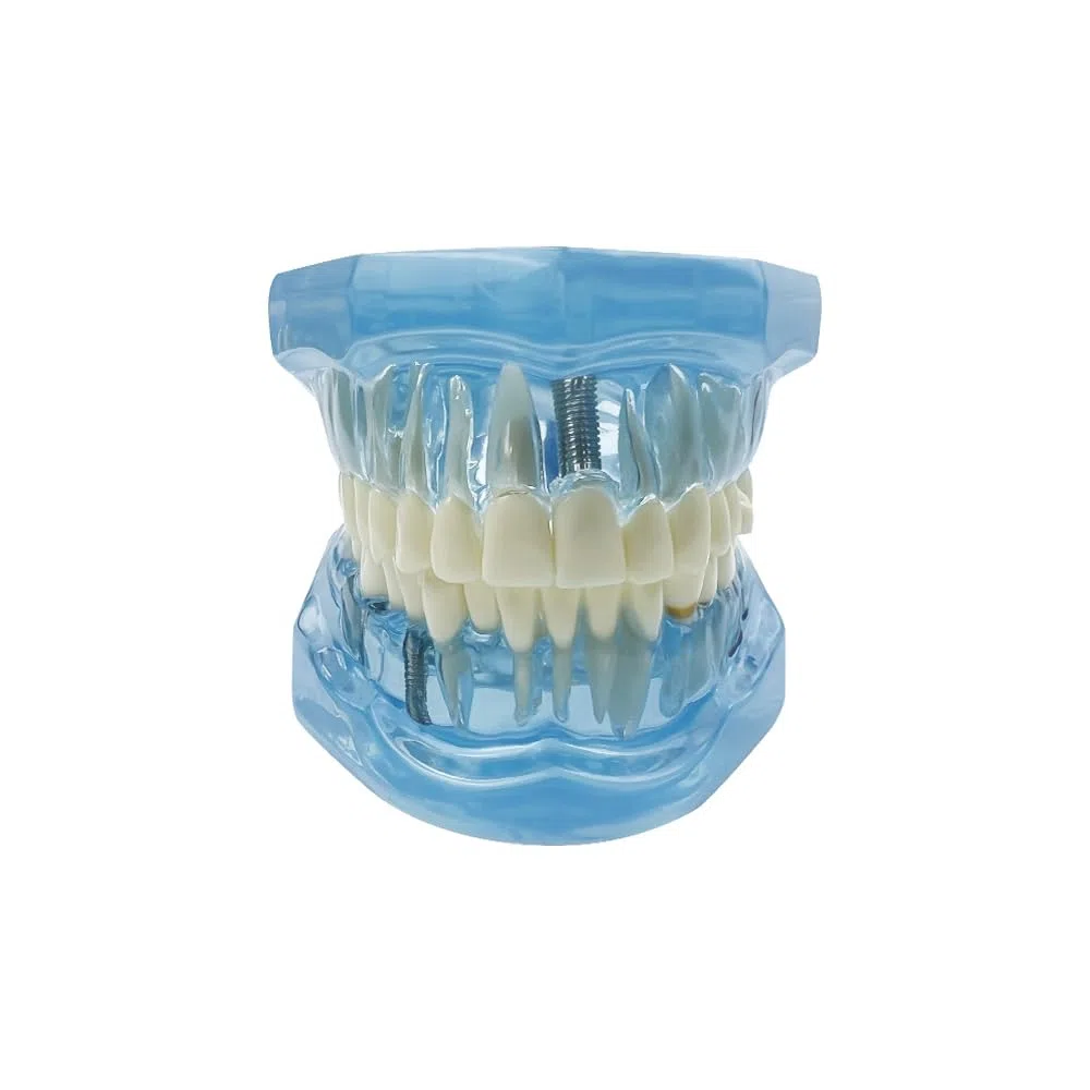 Implantación Enfermedad Dientes Modelo Dentista Estándar Pathológico Extraíble Herramientas de Enseñanza de Dientes (Azul)