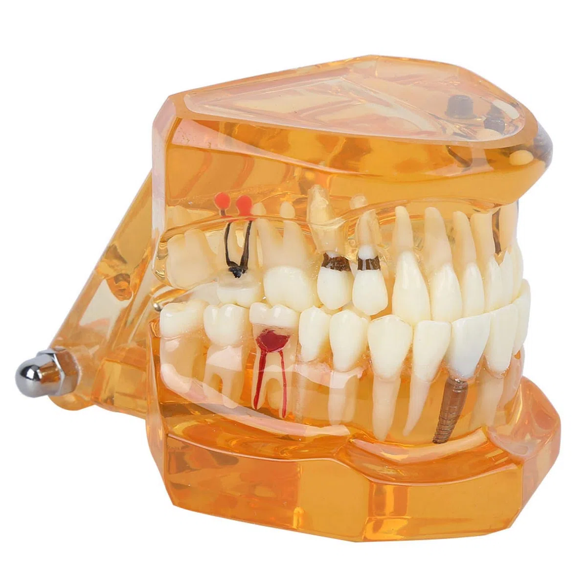 Joyzan Modelo de Dientes, Dientes Naranjas Demostración Color Enfermedad Dental Estudio Removible Diente para Enseñar Cámara Intraoral Material Implante Demostrativo Enseñanza Extraíble Enfermedades