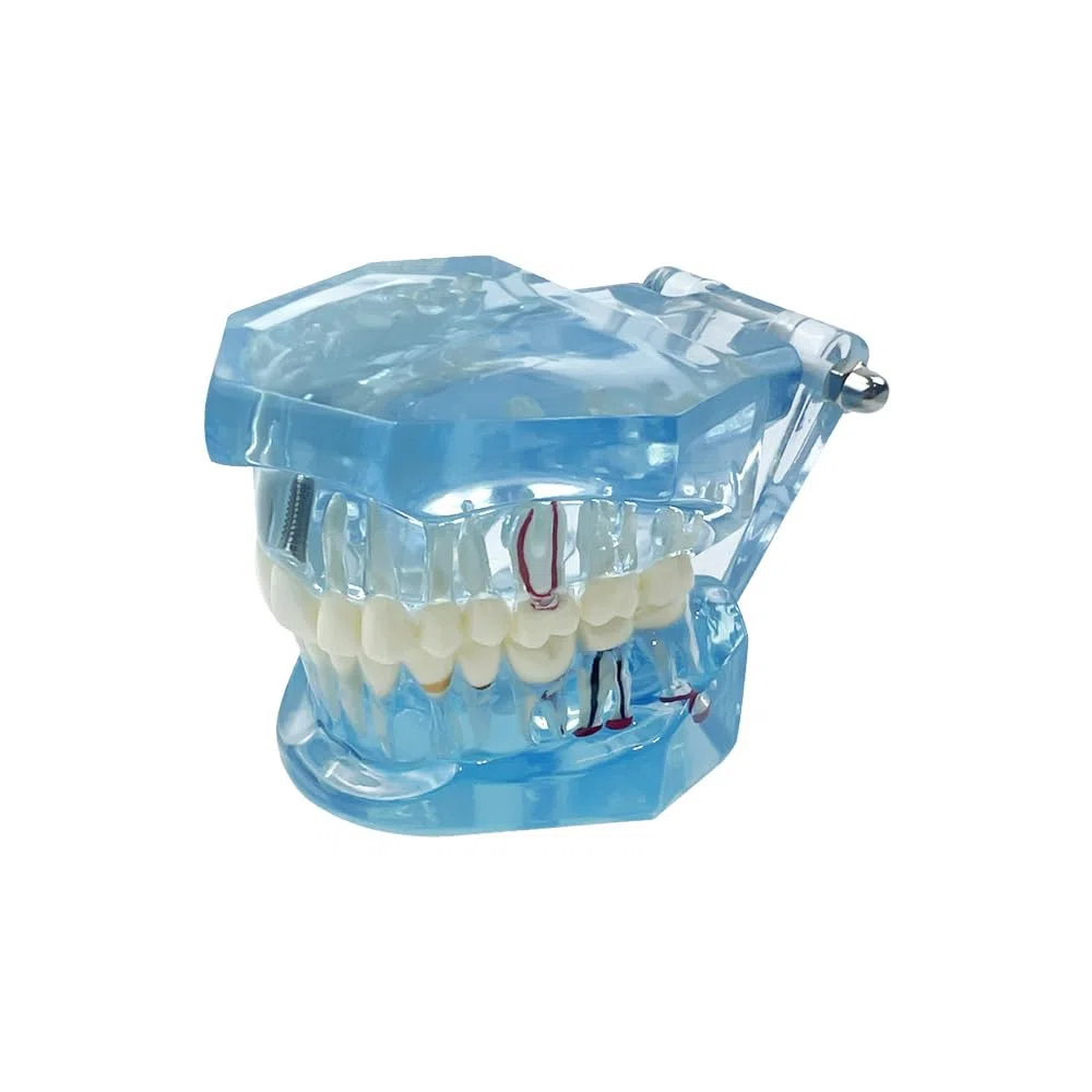 Implantación Enfermedad Dientes Modelo Dentista Estándar Pathológico Extraíble Herramientas de Enseñanza de Dientes (Azul)
