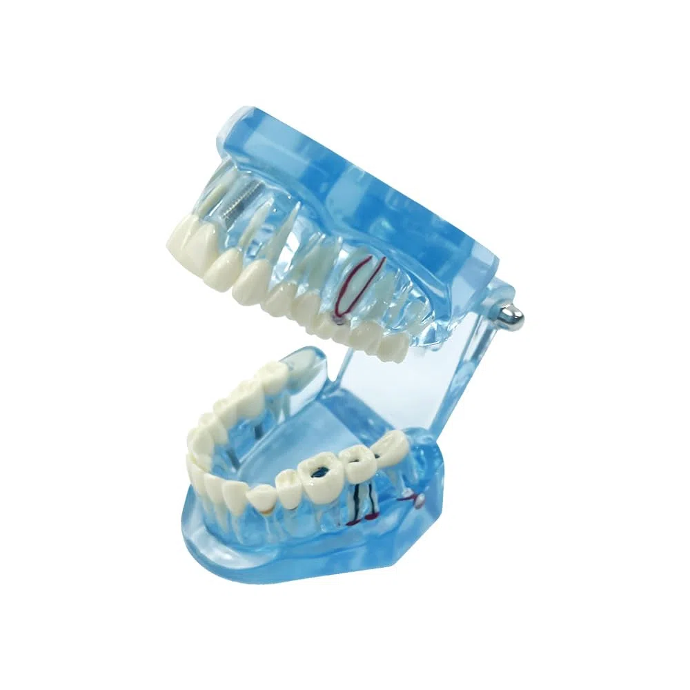 Implantación Enfermedad Dientes Modelo Dentista Estándar Pathológico Extraíble Herramientas de Enseñanza de Dientes (Azul)