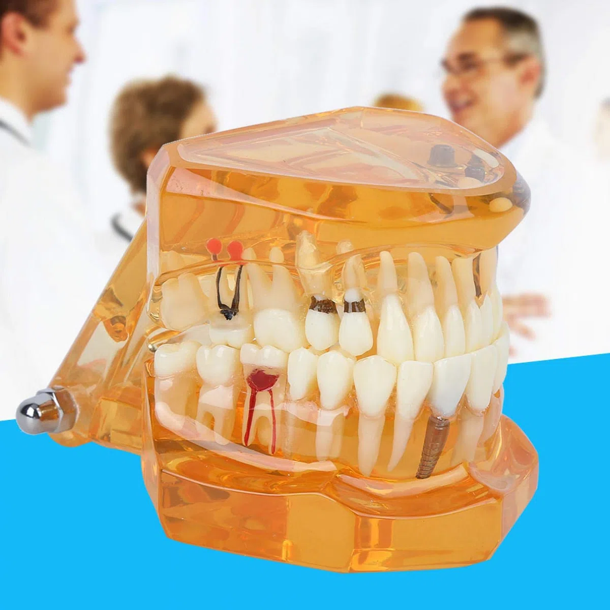 Joyzan Modelo de Dientes, Dientes Naranjas Demostración Color Enfermedad Dental Estudio Removible Diente para Enseñar Cámara Intraoral Material Implante Demostrativo Enseñanza Extraíble Enfermedades