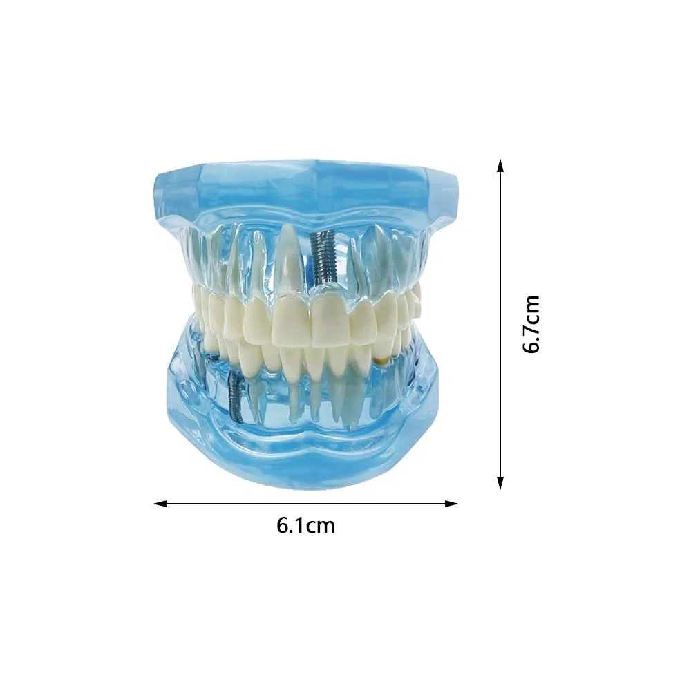 Implantación Enfermedad Dientes Modelo Dentista Estándar Pathológico Extraíble Herramientas de Enseñanza de Dientes (Azul)