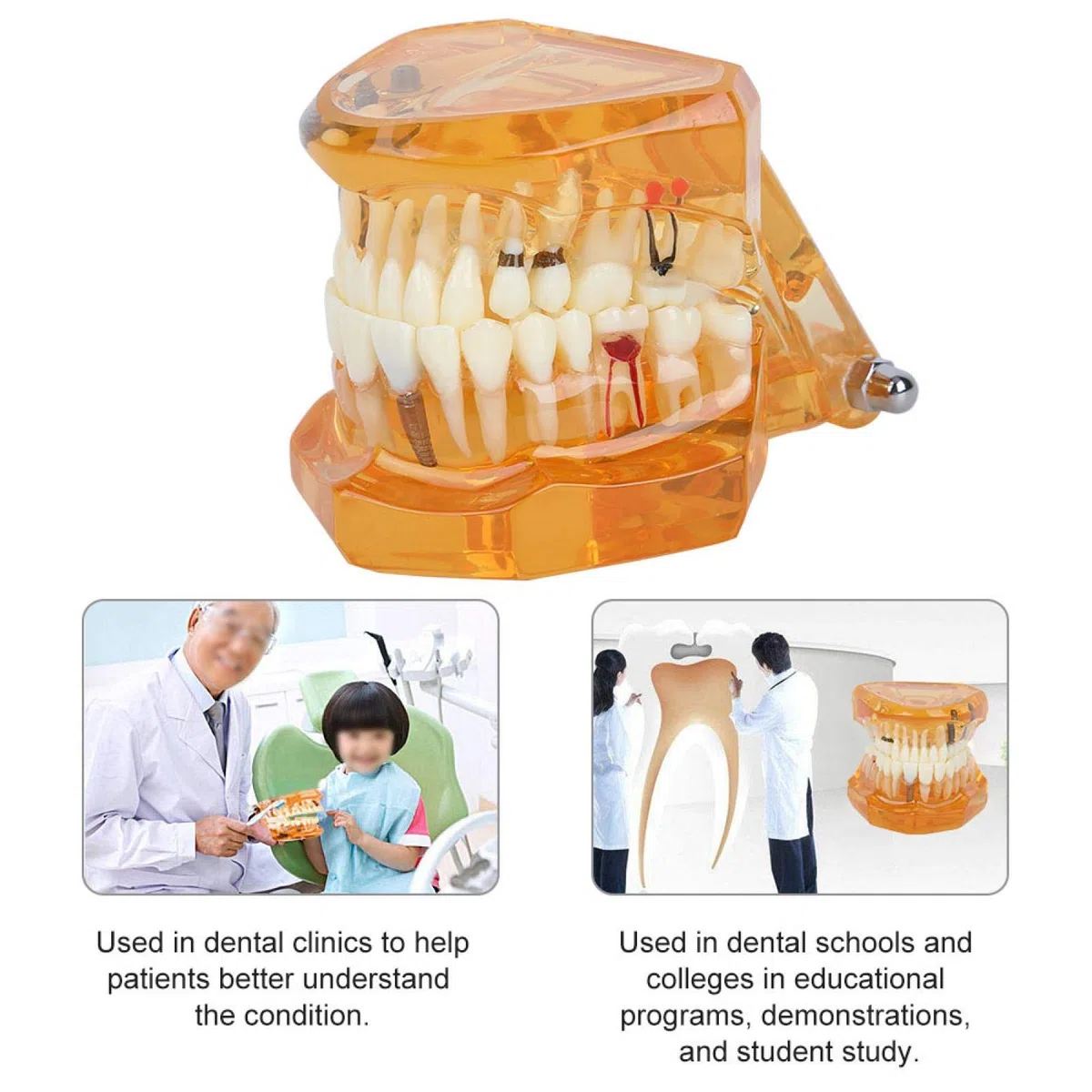 Joyzan Modelo de Dientes, Dientes Naranjas Demostración Color Enfermedad Dental Estudio Removible Diente para Enseñar Cámara Intraoral Material Implante Demostrativo Enseñanza Extraíble Enfermedades