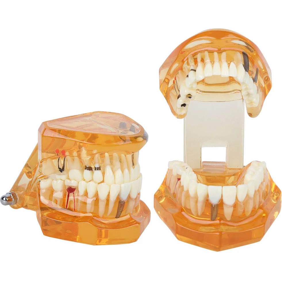 Joyzan Modelo de Dientes, Dientes Naranjas Demostración Color Enfermedad Dental Estudio Removible Diente para Enseñar Cámara Intraoral Material Implante Demostrativo Enseñanza Extraíble Enfermedades