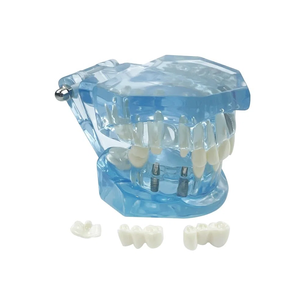 Implantación Enfermedad Dientes Modelo Dentista Estándar Pathológico Extraíble Herramientas de Enseñanza de Dientes (Azul)